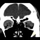 Endocrine orbitopathy, exophthalmus: CT - Computed tomography